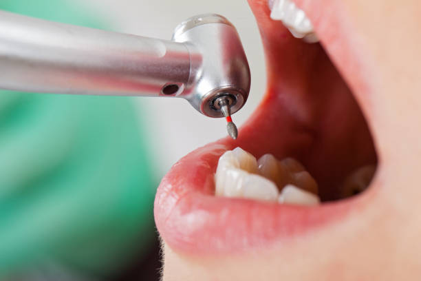 Best Emergency Tooth Extraction in Heyworth, IL